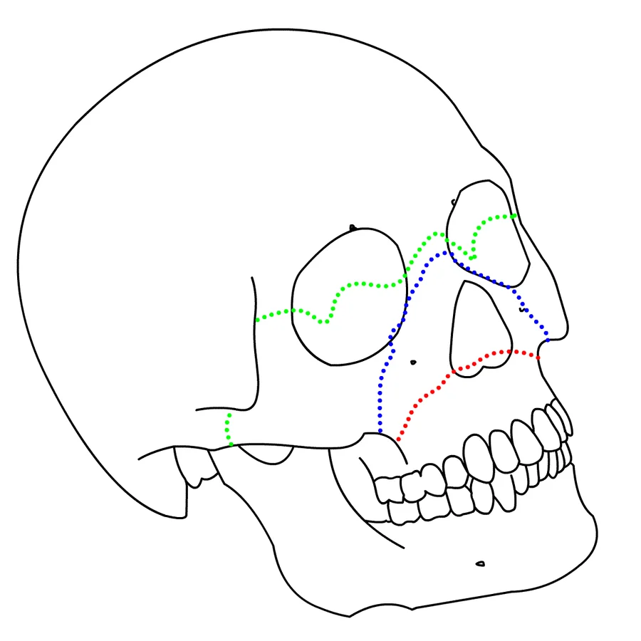 Lateral drawing of the skull with the upper jaw fracture lines marked in three separate colours